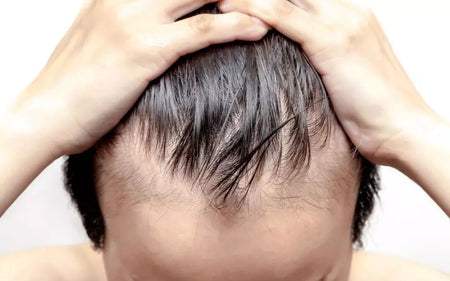 Hair Loss in Men Starts at an Early Age-Here’s the Reasons?