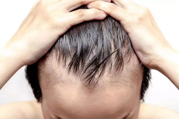 Hair Loss in Men Starts at an Early Age-Here’s the Reasons?